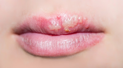 REMEDIOS NATURALES PARA ELIMINAR RÁPIDAMENTE EL HERPES LABIAL O FUEGO