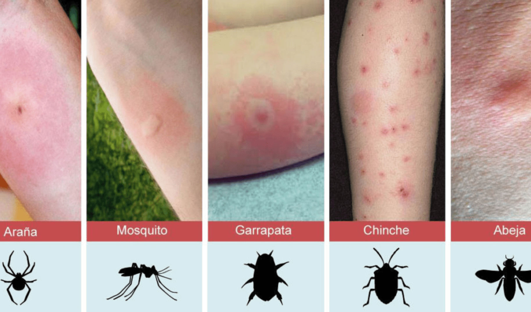 Te Picó Algo Y ¿No Sabes Qué Es? Aquí Te Decimos Cómo Identificar Las 7 Picaduras Más Comunes